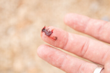 Injured finger with bleeding open cut