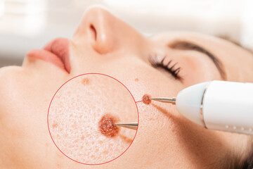Electrocoagulation and laser cosmelotogy. Dermatologist using a professional electrocautery for...