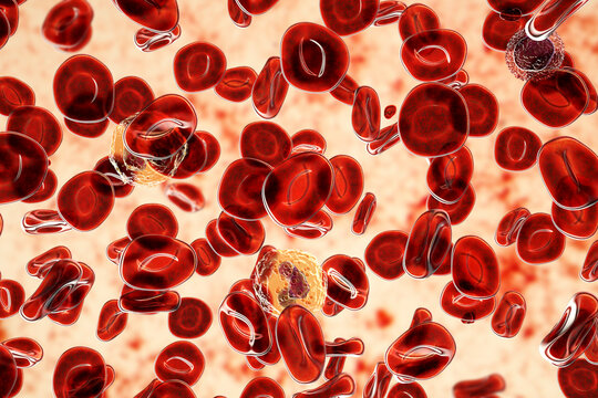 Polycythemia vera, a rare slow-growing blood cancer with an increase in the number of red blood cells