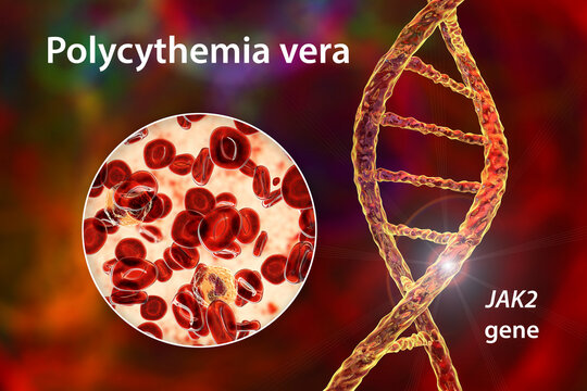 Polycythemia vera, a rare slow-growing blood cancer with an increase in the number of red blood cells