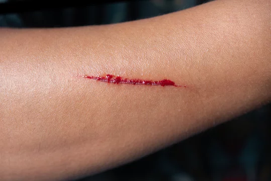Arm bleeding from scratch Stock Photo | Adobe Stock