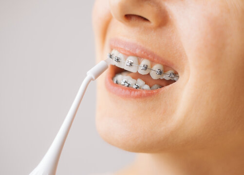 Smiling young unrecognizable woman with braces cleaning her teeth with oral irrigator, close-up. Dental hygiene.
