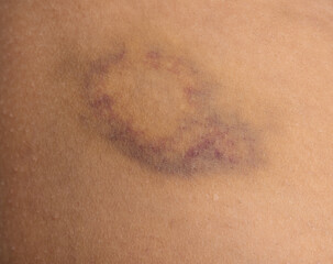 bruise on the skin as a background