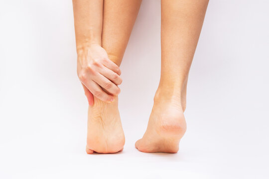 Foot pain from uncomfortable shoes. Female feet with flaky skin and corns isolated on a white background. A woman holds a sore heel with her hand. Pathology of bone structures, flat feet. Orthodontics