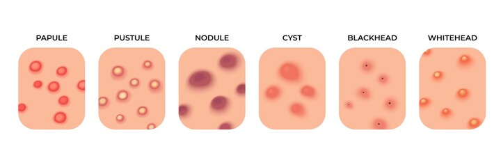 Acne types. Facial infections, pimples and skin inflammation. Skincare, face acne breakout. Dermatology epidermis disease recent vector set
