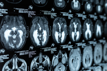 MRI scan or magnetic resonance image of the brain showed obstructive triventricular hydrocephalus....