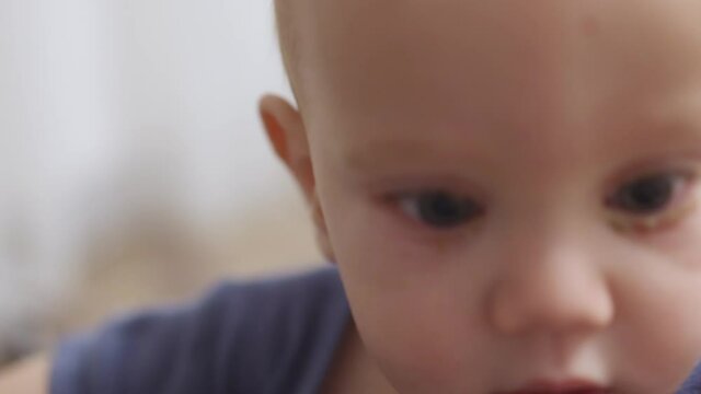 close-up view of blue eyed caucasian baby face with pink eye conjunctivitis. infant child eyes infection, irritation of bacteria or viruses. allergy on infants, viral blepharitis ophthalmology illness