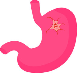 Illustration of the formation of stomach ulcers due to Helicobacter pylori. Gastroenterological disease. Gastritis and ulcers of the stomach and duodenum.