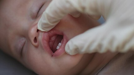 doctor dentist hands fingers in white gloves check sleeping caucasian baby infant first upper and low milk teeth eruption. kid child teething in swollen gums dentition in mouth