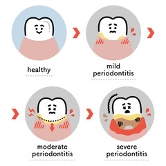歯周病の進行　イラストセット（英語ver.）