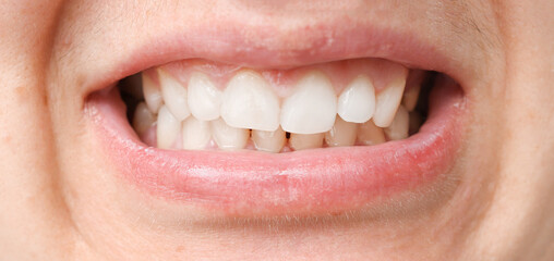 Mouth with white teeth, malocclusion, health problem. Close-up occlusion, misalignment.