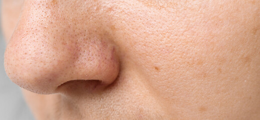 Acne, pimples on the nose close-up. Problematic facial skin, poor hygiene. Beauty and body care concept.