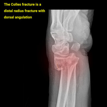 x ray of a colles fracture broken hand