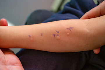 Skin Prick Allergy Test on a little child's arm,  positive results closeup