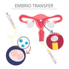 vector illustrations for gynecology. In vitro fertilization treatment of infertility, ovary cycle strokes, and font expended. 