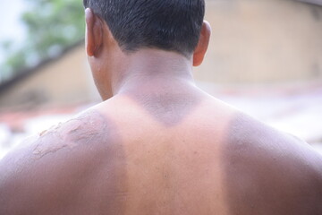 Extra sun-scorched shoulders and neck skin, The body part between the lateral upper joint of the...