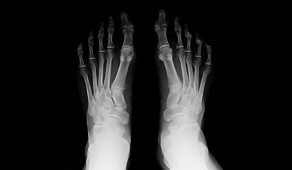 human right and left foot ankle xray picture (top view)