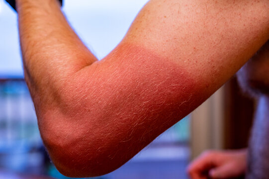 Arm With Visible Red Sunburn Caused By Wearing A Shirt