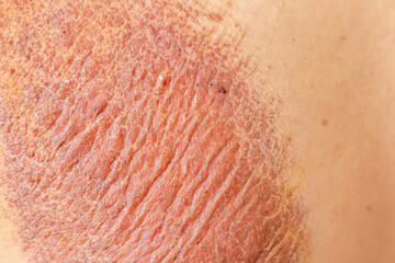 Fototapeta premium The wounds on the young man's body, which improved after the motorcycle accident, left wounds on his body and were hospitalized until the injuries and wounds improved.