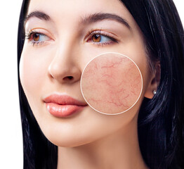 Young woman with couperose on face skin in zoom circle.