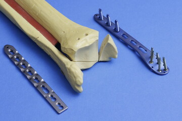 Surgical plates and instruments for osteosynthesis of bone fractures