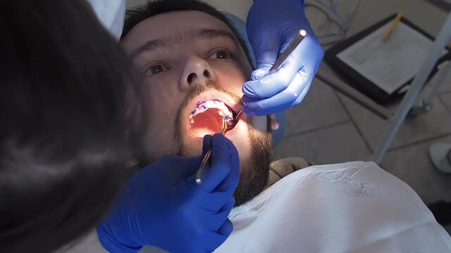 Dentist applying blue gel on man teeth to find dental tartar and caries closeup. Hygiene care for oral cavity. Prophylactic cleaning of teeth in stomatology clinic