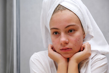 Acne. A sad teenage girl. Problematic skin in adolescents.