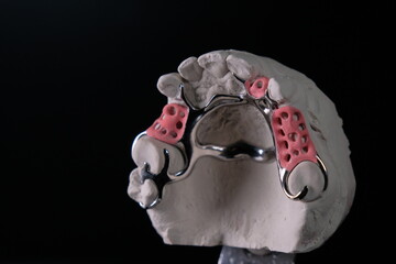 Removable clasp prosthesis of the upper jaw - obrazy, fototapety, plakaty