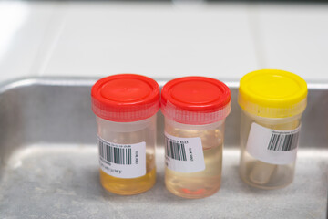 urine samples in the laboratory in the hospital
