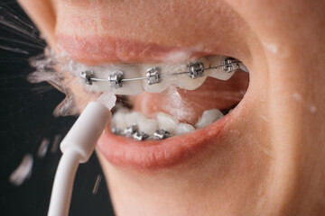 Close-up teeth with braces and an irrigator. A young unrecognizable woman uses an irrigator. Dental...