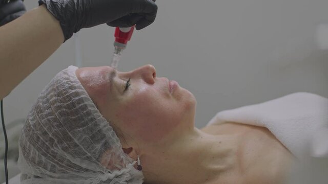 Close-up of a woman face. Needle mesotherapy procedure into the skin of the face