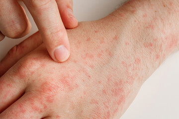 Fototapeta premium Hands with allergy reaction from taking medicines. By-effect, dermatology. Patient points on red spots on skin with forefinger, closeup