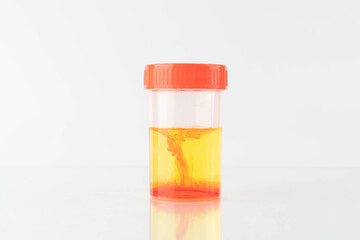 Blood in urine (hematuria) sample bottle in laboratory. Cause of hematuria included urinary tract...