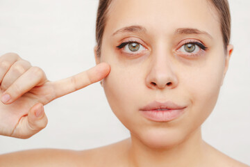 A young caucasian woman pointing dark circles under the eyes with her finger. Bruises under the...