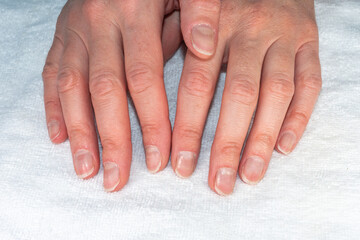 Caucasian female hands with natural broken unpolished nails, overgrown cuticles on a textile white background