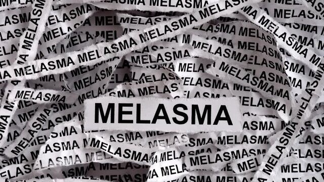 Melasma. Torn pieces of paper with the word Melasma on them.
