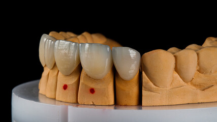 Four Ceramic Veneers Dental on Models