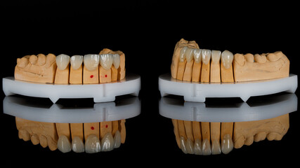 Two models with ceramic dental veneers for upper and lower cutters