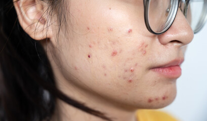 Close up of Asian woman having acne inflamed on her face. Inflamed acne consists of swelling,...