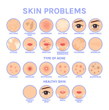 Skin Problems. Set of Icons for Different Skin Diseases of Face. Before After. Healthy Perfect Clean skin. Illustration for Medical and Cosmetic Design. White background. Flat Cartoon style. Vector.