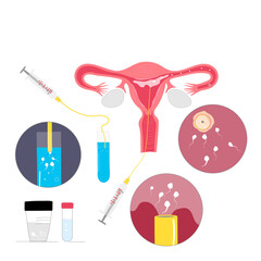 Intrauterine donor insemination vector colored illustration
