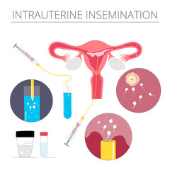 Intrauterine donor insemination vector colored illustration