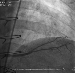 Coronary angiogram (CAG) was performed saphenous vein graft (SVG) to posterior lateral artery (PL) in patient post coronary artery bypass graft (CABG). - obrazy, fototapety, plakaty