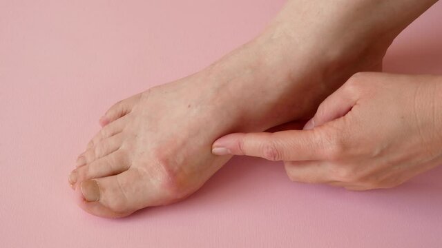 woman's hand massaging her bunion toes in bare feet to relieve pain on pink background Woman feet problem. Hallux valgus.