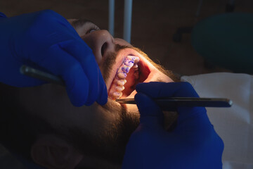 Professional oral hygiene and teeth cleaning. Applying the gel to the teeth. Prevention of caries...
