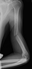x ray image of non union old fracture humerus .porotik bone 