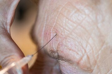 Eine ältere Frau Dame Oma bekommt eine medizinische Behandlung mit Nadel Injektion Spritze in die...