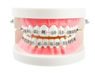Teeth model wire dental braces isolated on white background.