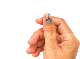 An old woman right hand showing bleeding, bruising under a thumb nail (selective focus) that hurt...
