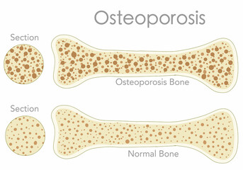 Porous bone, Osteoporosis. Bone cross section, structure. Pair, normal, health, mass and pore, fragile, spongy, osteoporotic bone, anatomy diagram. White back, textures. Medical illustration vector - obrazy, fototapety, plakaty